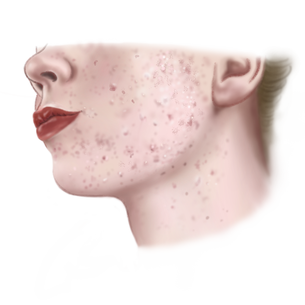 Acne Oorzaken Behandeling En Tips Drs Leenarts Dermatoloog