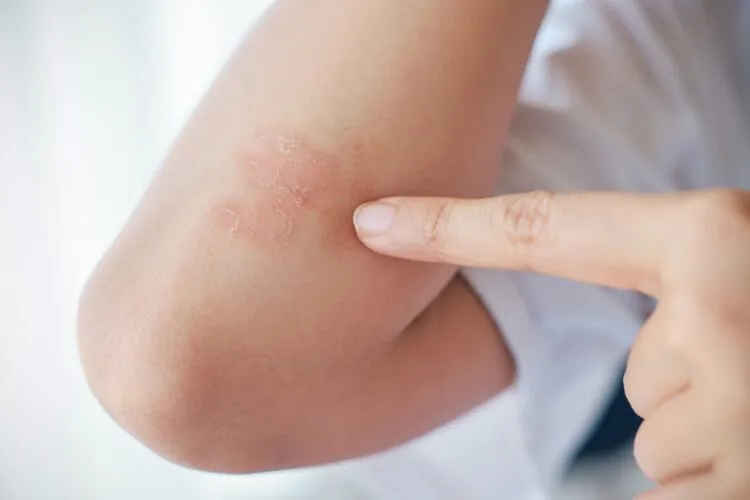 7 tips voor huidverzorging psoriasis